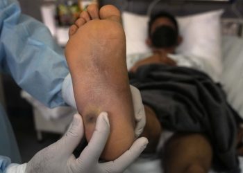 Identifican en Perú el primer linaje sudamericano de la viruela del mono y -no es el único-