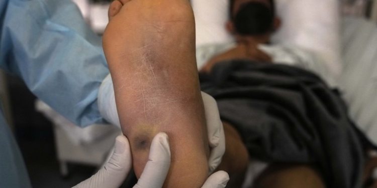 Identifican en Perú el primer linaje sudamericano de la viruela del mono y -no es el único-