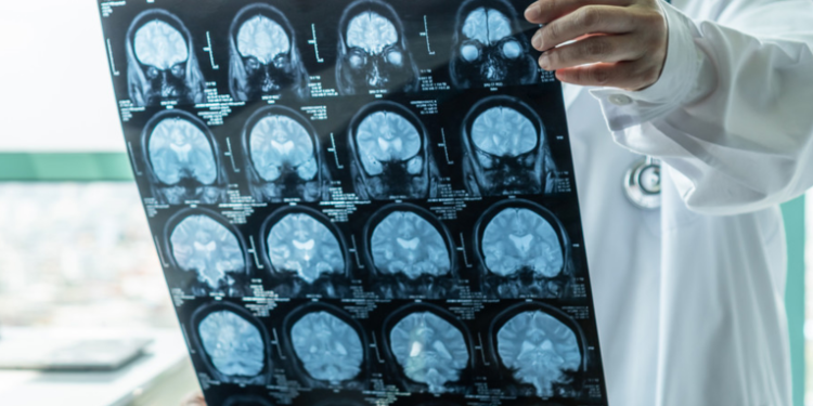 Inician en EE.UU. el primer ensayo clí­nico de una vacuna nasal contra el alzhéimer