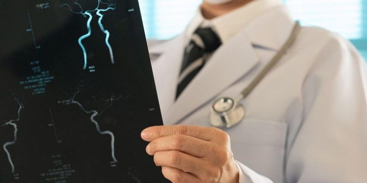 La mortalidad por ictus baja un 30%, pero deja secuelas invisibles con las que convivir