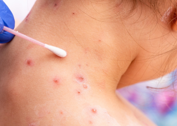 La OMS clasifica al brote de la viruela del mono como una emergencia sanitaria mundial