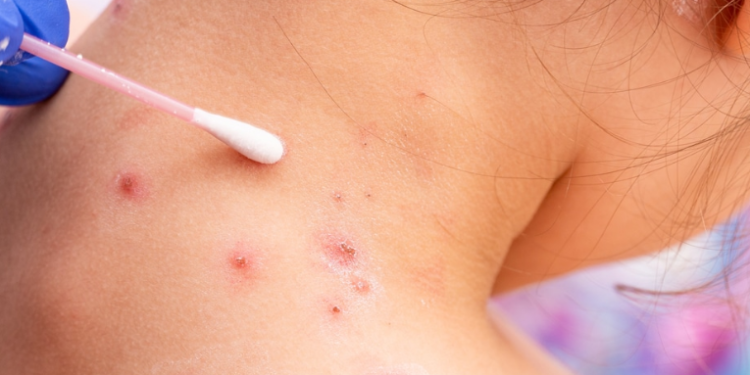 La OMS clasifica al brote de la viruela del mono como una emergencia sanitaria mundial