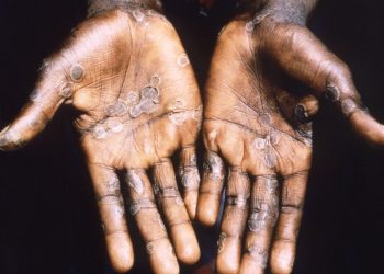 La OMS registra más de 3.400 casos de viruela del mono en 50 paí­ses desde inicios de este año