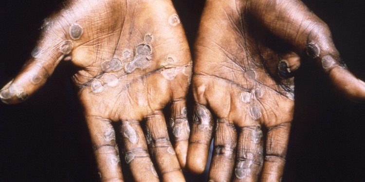 La OMS registra más de 3.400 casos de viruela del mono en 50 países desde inicios de este año