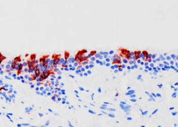 La variante ómicron se multiplica 70 veces más rápido en los bronquios que la delta pero la infección pulmonar es mucho menor.