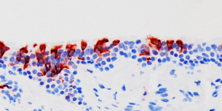 La variante ómicron se multiplica 70 veces más rápido en los bronquios que la delta pero la infección pulmonar es mucho menor.