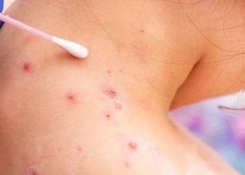 Laboratorio Nacional del ministerio de SaludÂ reporta treintaÂ nuevos casos de viruela del mono