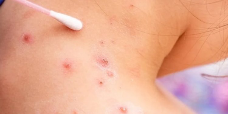 Laboratorio Nacional del ministerio de Salud reporta treinta nuevos casos de viruela del mono