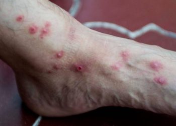 Las autoridades de salud reportan 15 nuevo casos de viruela del mono en el paí­s