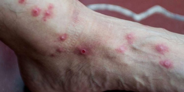 Las autoridades de salud reportan 15 nuevo casos de viruela del mono en el paí­s