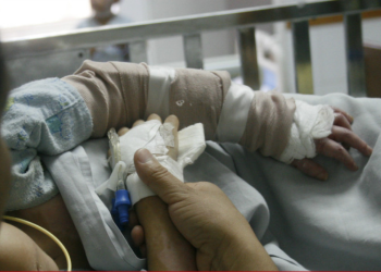 Más de 80 mil personas registran quemaduras anualmente en el Hospital Roosevelt