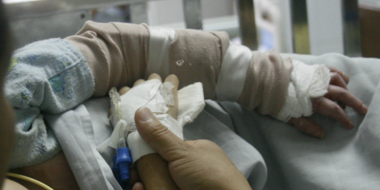 Más de 80 mil personas registran quemaduras anualmente en el Hospital Roosevelt