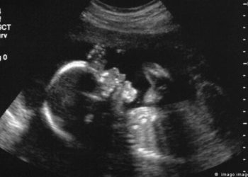 Médicos logran realizar con éxito la primera cirugí­a cerebral de un feto