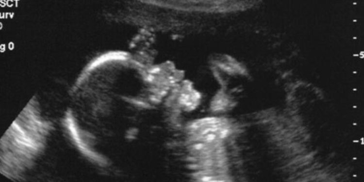 Médicos logran realizar con éxito la primera cirugí­a cerebral de un feto