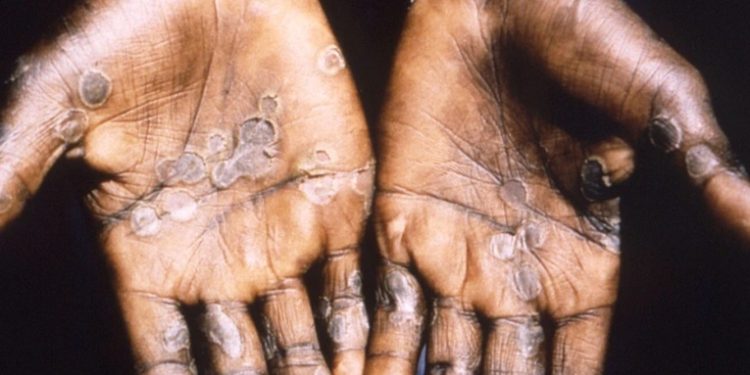 México confirma su primer caso de viruela del mono