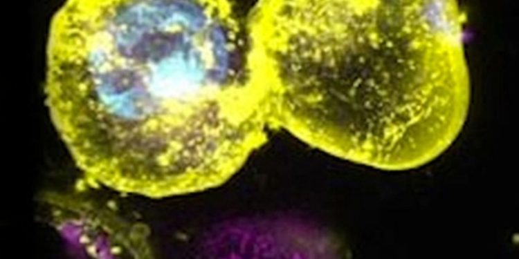 Millones de personas portan una mutación genética que aumenta el riesgo de muerte celular explosiva