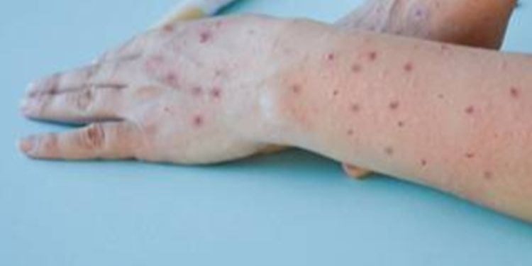 Ministerio de Salud confirmó el tercer caso de Viruela del Mono en el paí­s