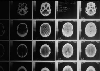 Nuevo gel detiene los tumores cerebrales en ratones con una eficacia del 100%