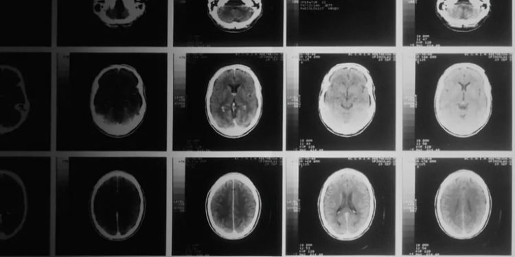 Nuevo gel detiene los tumores cerebrales en ratones con una eficacia del 100%