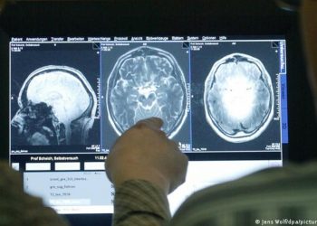 Nuevo medicamento entrega resultados prometedores en tratamiento contra el Alzheimer