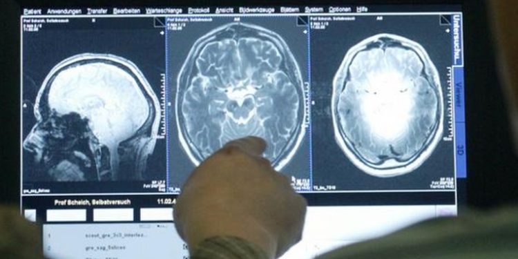 Nuevo medicamento entrega resultados prometedores en tratamiento contra el Alzheimer
