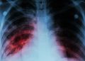 OMS advierte que la tuberculosis vuelve a propagarse por el mundo