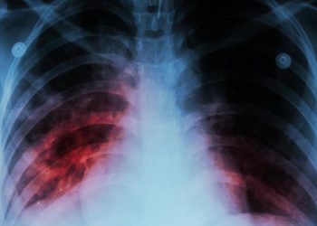 OMS advierte que la tuberculosis vuelve a propagarse por el mundo