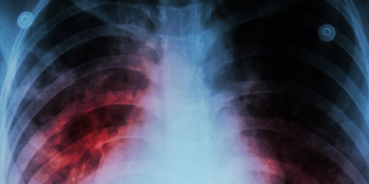 OMS advierte que la tuberculosis vuelve a propagarse por el mundo