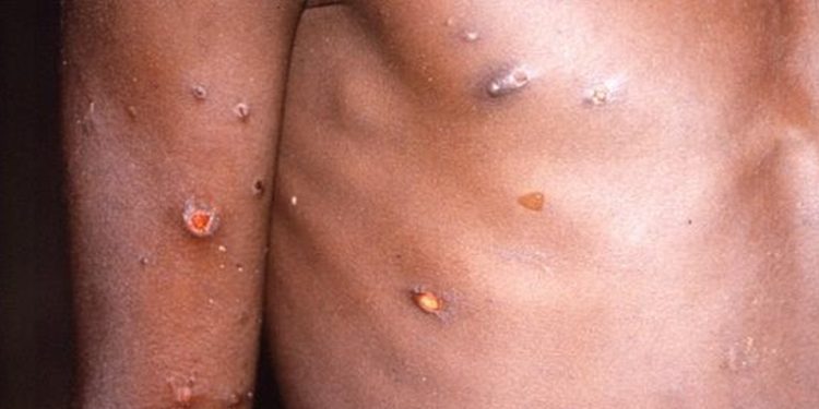 OMS confirma más de 80 casos de viruela del mono en 12 paí­ses