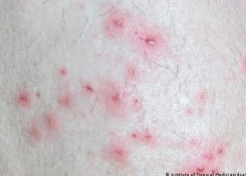 OMS reporta 780 casos de viruela del mono, la mayorí­a en Europa