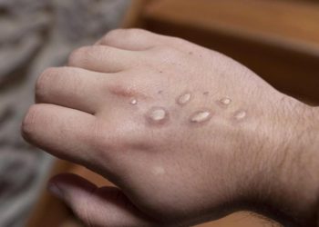 Piden a padres de familia evitar que niños con heridas en la piel asistan a la escuela