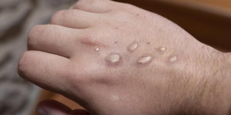 Piden a padres de familia evitar que niños con heridas en la piel asistan a la escuela