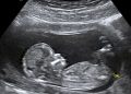 Presentan reforma para impedir la legalización del aborto en Honduras