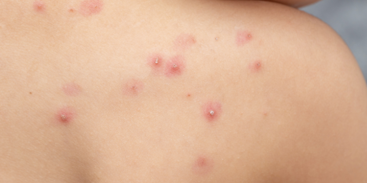 Salud confirma 14 casos nuevos de Viruela del mono en el paí­s