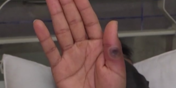 Salud confirma 21 nuevos casos de viruela del mono en el paí­s