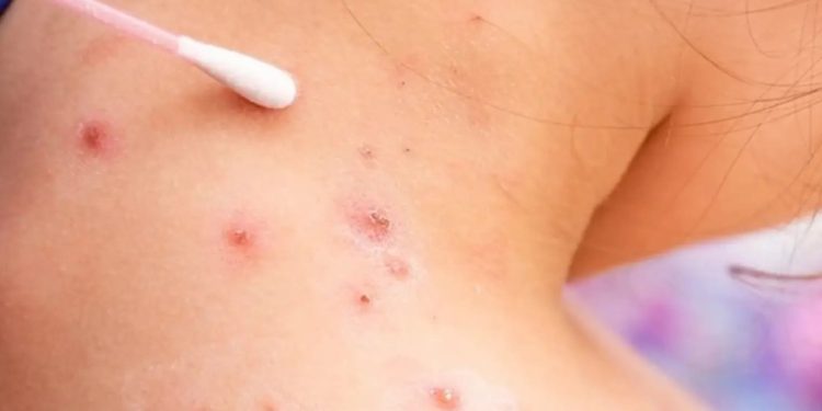 Se confirman tres nuevos casos de viruela del mono, con los que suman 18 infectados en el país