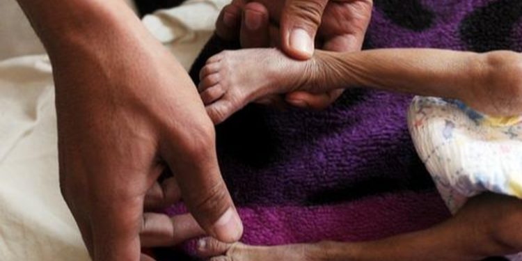 SESAN confirma la muerte de 68 niños por desnutrición aguda durante el 2022