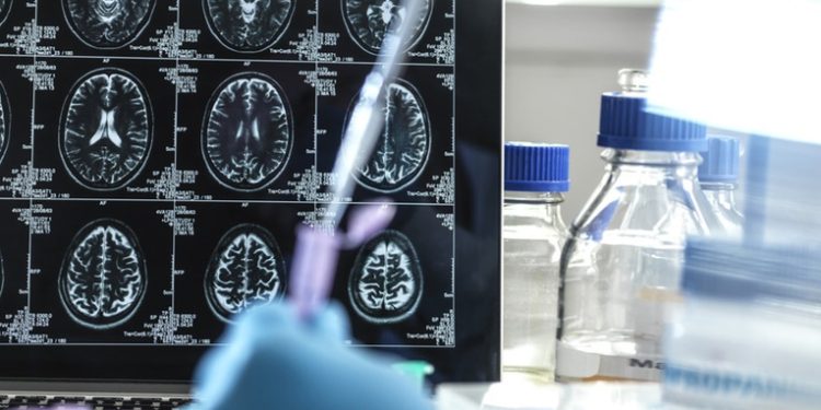 Un estudio descubre 42 nuevos genes relacionados con el riesgo de Alzheimer que permiten su diagnóstico temprano