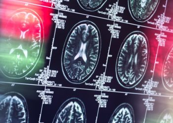 Un nuevo fármaco ralentiza el deterioro cognitivo por el alzhéimer en su etapa temprana