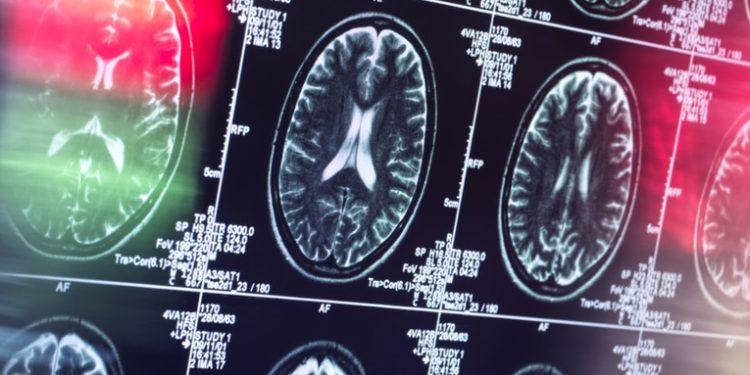Un nuevo fármaco ralentiza el deterioro cognitivo por el alzhéimer en su etapa temprana
