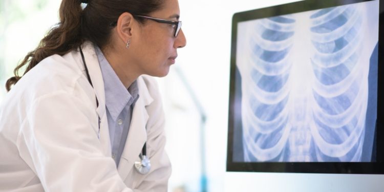 Un nuevo tratamiento en España logra erradicar el cáncer de pulmón en casi un 37 % de los casos