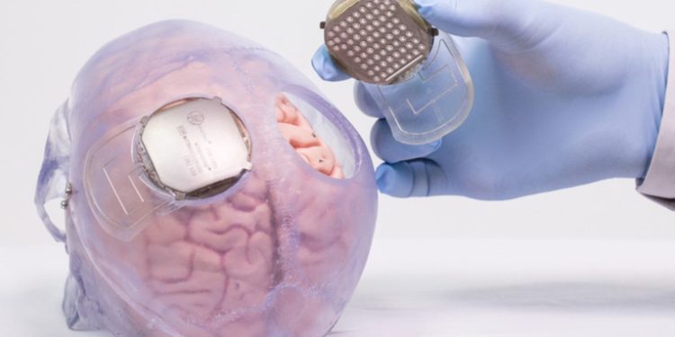 Un rival de Neuralink completa el primer implante humano de interfaz cerebro-ordenador en EE.UU.