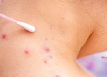 íšnicamente tres casos de la viruela del mono se han producido en el paí­s