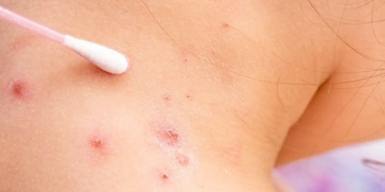 íšnicamente tres casos de la viruela del mono se han producido en el país