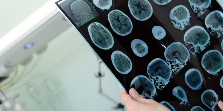 Uno de los estudios clave de los últimos 16 años sobre el alzhéimer pudo haber sido manipulado