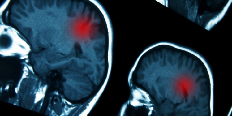 Vinculan ciertos fármacos hormonales con un mayor riesgo de tumores cerebrales