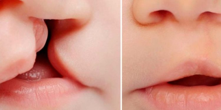 XXI jornada de operaciones de labio leporino y paladar hendido