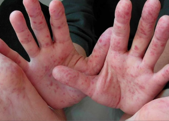 Virus en menores de edad