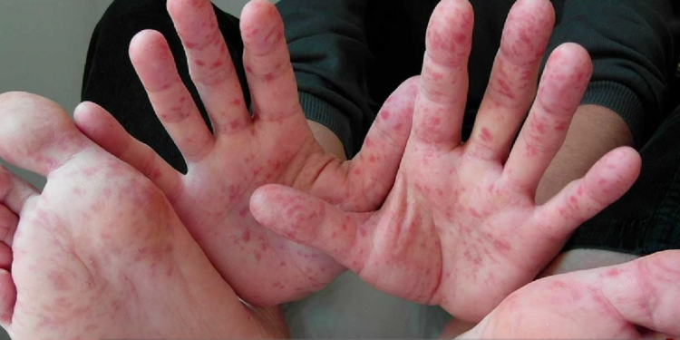 Virus en menores de edad