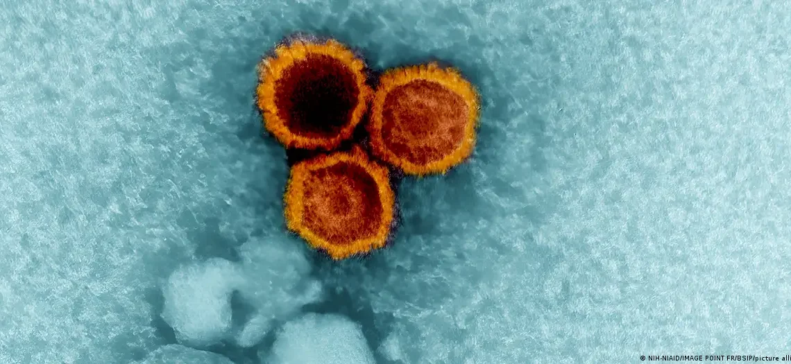 Virus Epstein-Barr y lupus